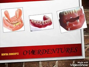 Overdentures