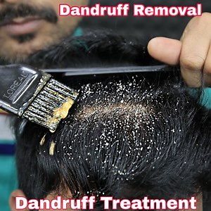 Satisfying Dandruff Scratching And Dandruff Treatment ASMR #DandruffScratching #DandruffTreatment #Homeasmrclinic | Home ASMR clinic