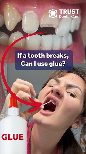 GLUE A BROKEN TOOTH? 🦷 #glue #brokenteeth #mexicodentist #tijuanadentist #reels | Trust Dental Care - Dentist in Tijuana