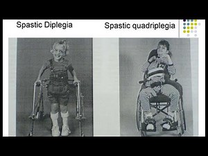 Cerebral Palsy (CP) | Spastic Diplegia Paraplegia Hemiplegia Sequelae Consequences Treatment Options