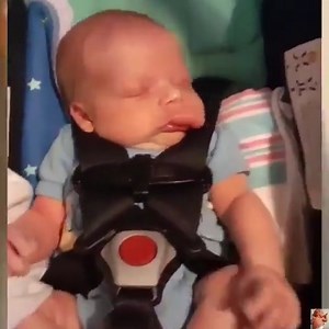 10K views · 643 reactions | Strong Baby With Hemangioma | Babies Daily TV | Facebook