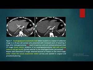 Concurrent Chest and Abdominal CT Managing Pitfalls of Splitting Interpretation by Subspecialty