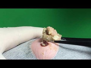 BEST Pimple Popping // Big Cystic Acne Blackheads // Whiteheads Removal / Squeezing Pimples / Hv#045