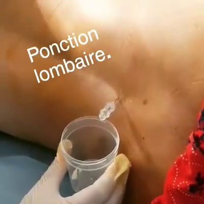 69K views · 645 reactions | Lumbar puncture is a medical procedure in which a needle is inserted into the spinal canal, most commonly to collect cerebrospinal fluid for diagnostic testing. In this case the CSF is clear and colorless, but we will still need lab results to look for bacterias or viruses (meningitis suspicion in this case) . Follow @dr.bengi and us for more educational content | Meddy Bear | Facebook