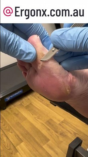 Ultimate Corn & Callus Removal from Big Toe at Podiatry Clinic #FootCare #Podiatry