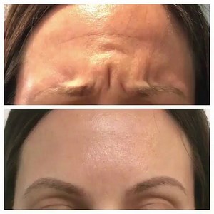 18 shares | This is what it looks like when your Botox is working!...