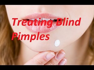 How to get rid of a blind pimple overnight | Remove Blind Pimple