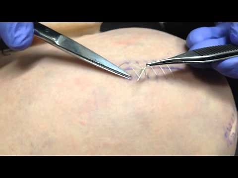 How to remove a running suture