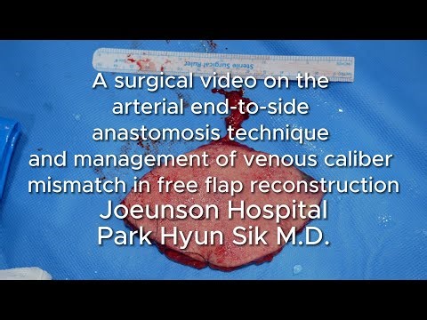 arterial end to side anastomosis, management of venous caliber mismatch in free flap reconstruction
