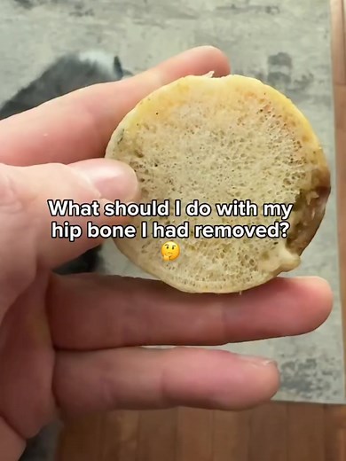 During a total hip replacement, the damaged femoral head (the ‘ball’ of your hip joint) is removed and replaced with an artificial implant designed to restore motion and relieve pain. Patients often ask: Do I get my hip bone back? In most cases, no. The removed bone is typically sent to pathology for routine evaluation and then disposed of according to medical regulations. While some facilities may allow patients to request it, this is uncommon and depends on hospital policy and local regulation