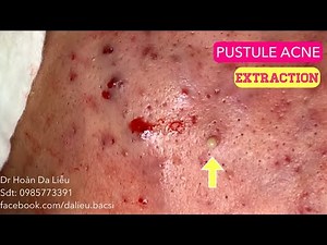 Trị mụn trứng cá mủ nặng|Dermatologist,pimples,blackhead,anti acne,pustule extraction 0985773391