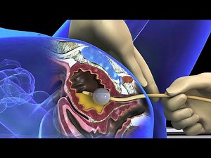 Foley catheter insertion procedure in females: 3d animation