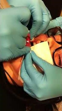 Tongue splitting procedure