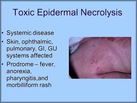Dermatology Emergencies: TEN vs Stevens Johnson Syndrome