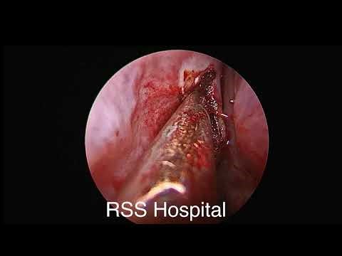 Live telecast of Bilateral Functional Endoscopic Sinus Surgery by Dr Hariom Sharma MBBS, MS