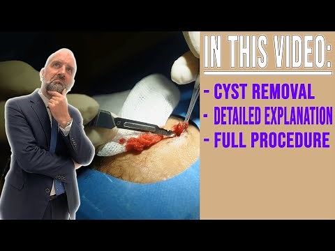 Forehead Cyst Removal - UK Plastic Surgeon