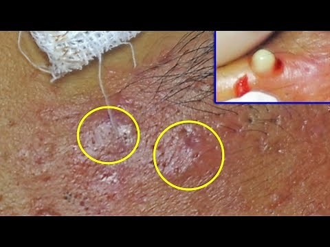 Extraction et drainage abscès de l'acné kystique sur le visage (Cystic Ance) | Partie 1