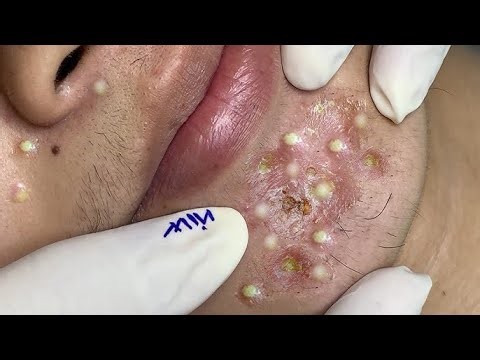 Real Pimple Popping ASMR 🔥 | Deep Acne & Blackheads Removal That Feels Unreal