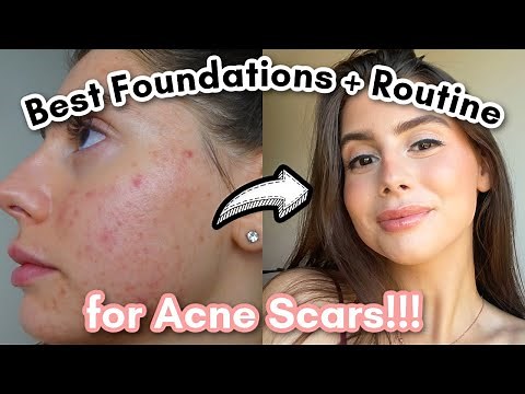 Best Foundation and Routine for Covering Acne Scars and Cystic Acne!!