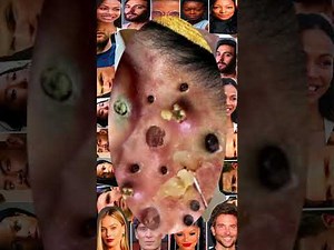 Blackheads Removal #270 | Acne Treatment and Very Satisfying Satisfying Pimple pop #blackheads