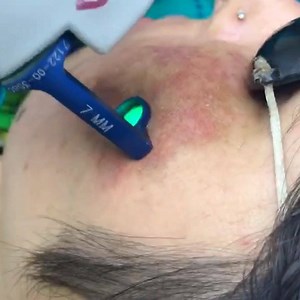 Pulsed dye laser (PDL)* The Pulsed Dye Laser, or PDL, uses a concentrated beam of light (595nm wavelength in Vbeam) that targets blood vessels in the skin. PDL was the first laser to utilize the concept of selective photothermolysis to treat dermatologic conditions. The first application of this concept was directed at treating port-wine stain birthmarks (PWSs). Advances in PDL technology allow for a myriad of vascular conditions, such as rosacea, scars, red striae and photodamage, etc. to be tr