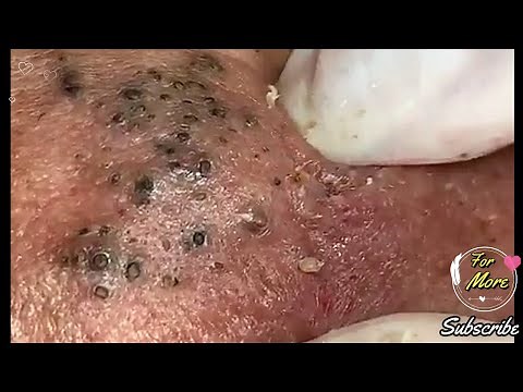 Dr Pop - Deep Blackheads in old Skin removing & treatment 2020 (Part 6)