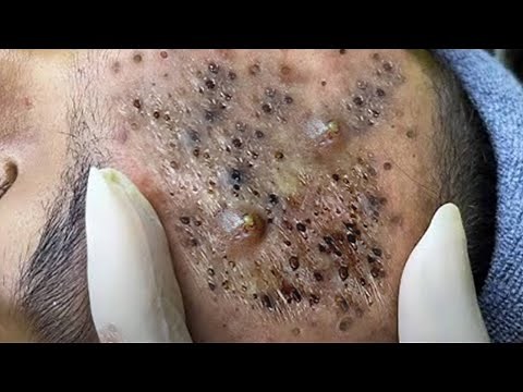 Big Cystic Acne Blackheads Extraction Blackheads & Milia, Whiteheads Removal Pimple Popping #229