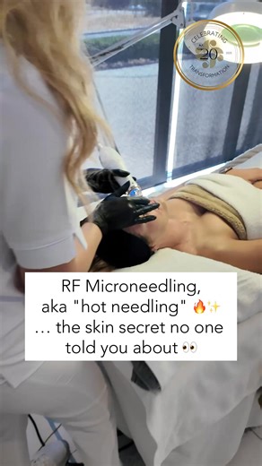 Hot Needling or RF Microneedling + PRF = Collagen's Wake Up Call...