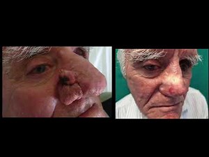 rhinophyma and bcc removal