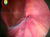This Needloscopic Procedure for Congenital Groin Hernia - Why Not Used Now • Video • MEDtube.net
