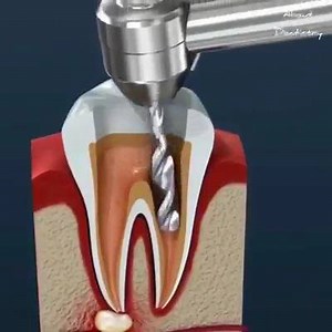 1K views | Root canal treatment is an often straightforward procedure to relieve dental pain and save your teeth. Patients typically need a root canal when there is inflammation or infection in the roots of a tooth. During root canal treatment, an endodontist who specializes in such treatment carefully removes the pulp inside the tooth, cleans, disinfects and shapes the root canals, and places a filling to seal the space. For more info please contact us | I Love Cebu Braces | Facebook