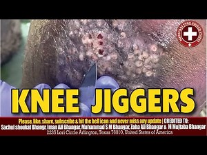 How to Safely Remove Jiggers from Your Knee | Effective Jigger Removal Tips