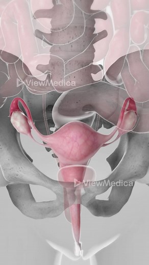 What is LEEP and why is it important? #leep #cervix #cervicalcancer #womenshealth #3dmedicalanimation #medicaleducation #3danimationsurgery