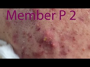 Acne Treatment Huong Da Nang# 038 | Loyal fans Mai Part 2