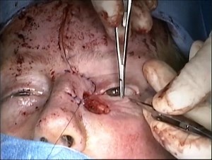 Median forehead and rotational flap for medial canthal defect