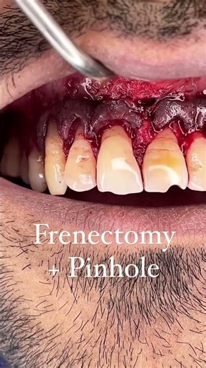 Gingival Recession - Treatment (Non-surgical, surgical) l Perio plastic surgery | Delhi Dentist