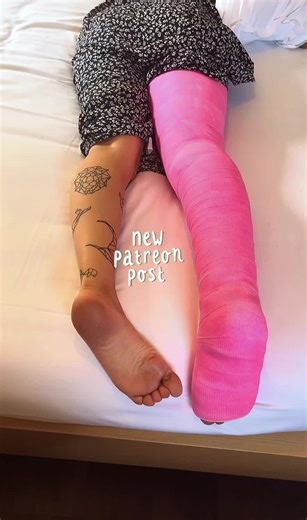 Caring for a Broken Ankle in a Pink Cast