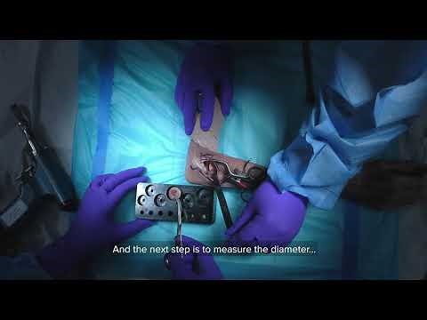 Remplazo de una Cabeza de Radio usando una Protesis Anatomica con Pablo De Carli, MD