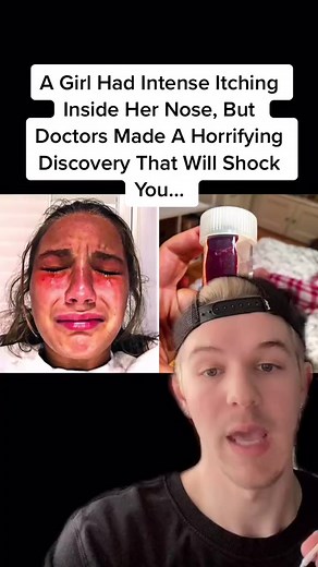 A Girl Had Intense Itching Inside Her Nose, But Doctors Made A Horrifying Discovery That Will Shock You... #fyp #foryou #truestory #storytime #story | Ian Gallagher | Facebook