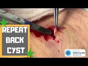 POP GOES THE BACK CYST