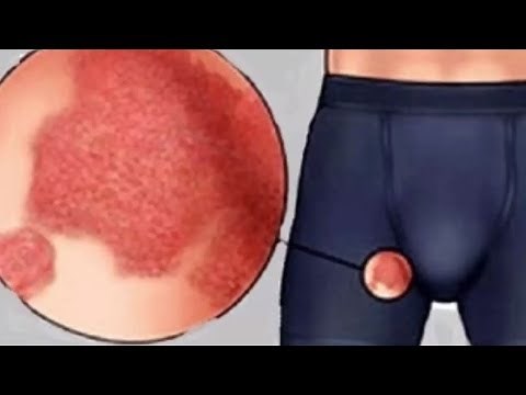 Home Remedies To Cure Fungal Infection Between Thighs | How to Get Rid of Jock Itch