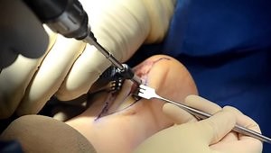 Haglund's Deformity Repair with Citregen-Based Knotless Suture Anchor