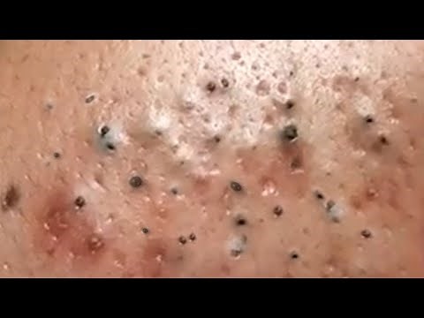 Dr. Sandra Lee acne treatment and removal blackheads (269) #blackheads #acnetreatment #acne