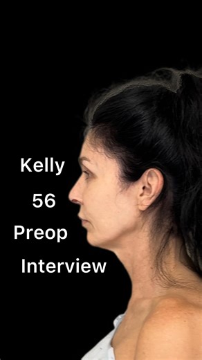 Dr. L. Mike Nayak on Instagram: "😱 It’s Nurse Kelly’s turn! Kelly is 56, and has been on my team for almost 9 years. In the past she has assisted me in the operating room, and is currently the lead member of my postoperative care team. Now, it’s her turn! Kelly’s surgery will include: ✅ Deep plane facelift ✅ Deep neck lift ✅ Brow lift ✅ Rhinoplasty ✅ Fat transfer to her temples ✅ Full face laser resurfacing Kelly is the sweetest person, and has supported so many people through recovery – I hope