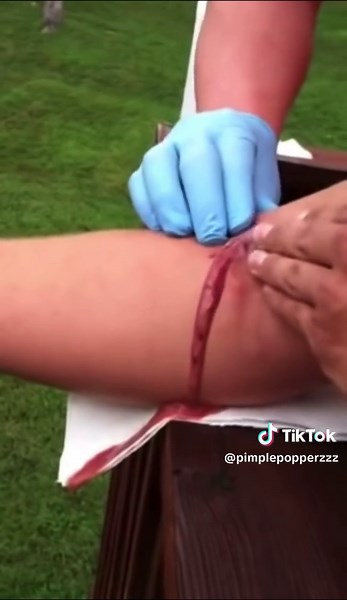 Infected spider bite pops and drains #abscess #spiderbite #cyst #infection #pimple #pimplepop #cystpopping #fypシ #fup #funnyvideos #fun #funnyvideo #funny #funnymoment #meme #mem #memes #memestiktok #FYP #foryou #foryoupage #fyp #foryourpage #asmr #ASMR #fypシ゚viral #youtube #shorts #viralvideo #viraltiktok #tiktok #tiktoker #memestiktok #oddlysatisfying #satisfyingvideo #acne #blackheads #whiteheads #zit #zithappens #pimples #drpimplepopper #pimplepopperaddict #pop #pimplepop @Sandra Lee, MD