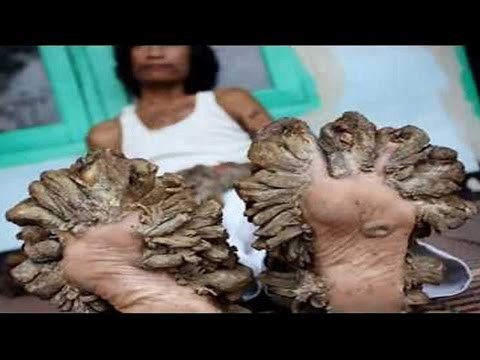 Tree Man of Indonesian dies of battling rare illness