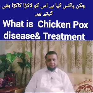 2.1K views · 46 reactions | What is Chicken Pox, Chicken Pox Treatment,Chicken Pox Symptoms & Signs of Chicken Pox #foryou #trending#trend#viral#viralpost#viralvideo#viralreels#diabetes#cancer#heartattack. | Dynamic Health with Dr. G.A | Facebook