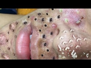 Blackhead Removal With Sac Dep Spa @100074728