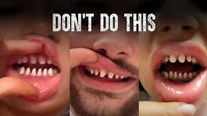 The TikTok veneer trend and its hidden risks
