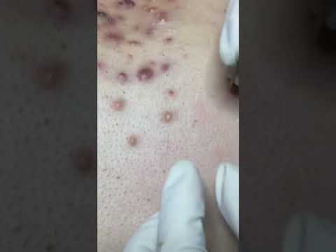 Removal acne on chest!
